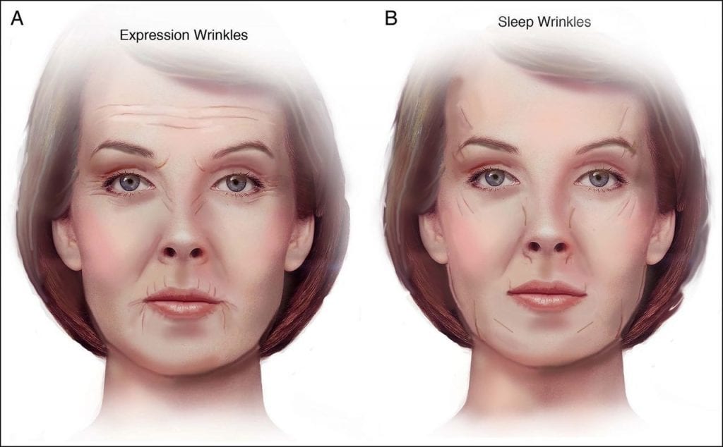 Does Sleeping On Your Side Cause Wrinkles? BOTOX® & JUVÉDERM® Fillers