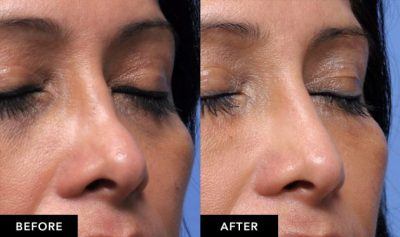 Surgical vs. Non Surgical Nose Job| Nose Filler in San Francisco