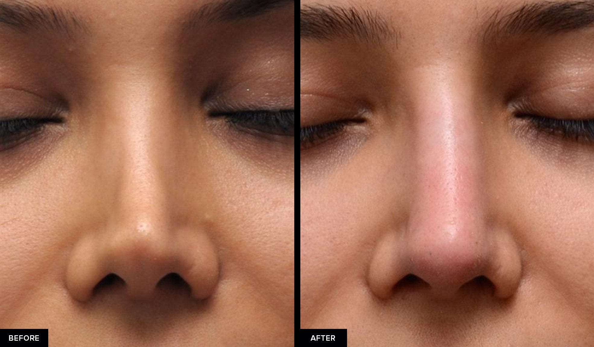 bad rhinoplasty before and after