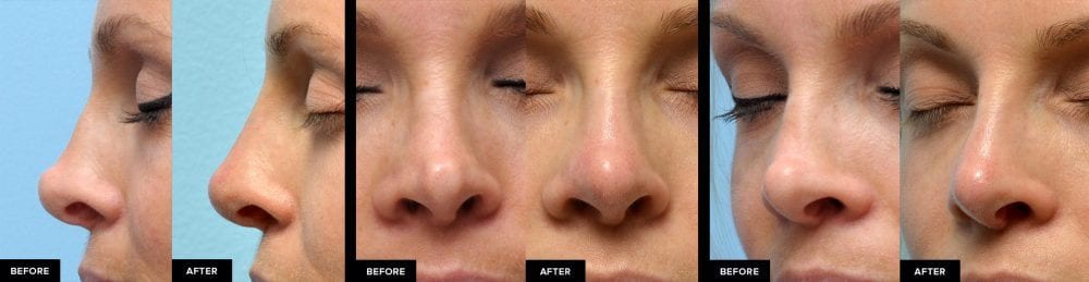 Non Surgical Nose Job After Rhinoplasty Is It Safe Updated 2023 Mabrie Facial Institute