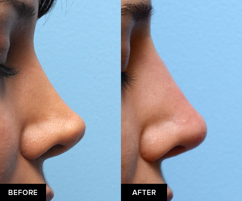 Nonsurgical Revision Rhinoplasty In San Francisco Dr David Mabrie