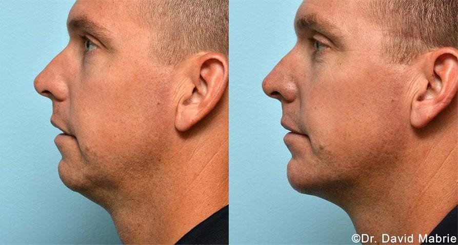 Nonsurgical Chin Augmentation, Neck Slimming & Jaw Contouring in San ...