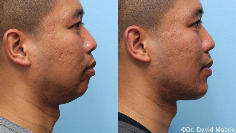 nonsurgical-chin-augmentation-neck-slimming-jaw-contouring-in-san