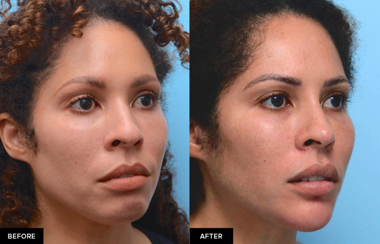 Jawline Filler For Definition And Contour Updated 2023 Mabrie Facial Institute 3171