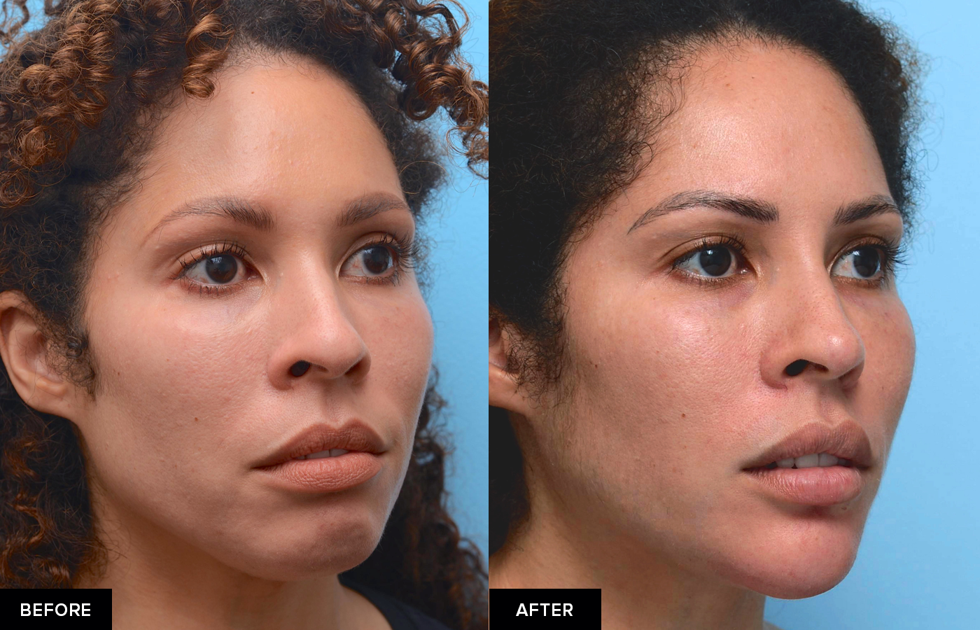 Jawline Filler For Definition And Contour Updated 2023 Mabrie Facial Institute 8228