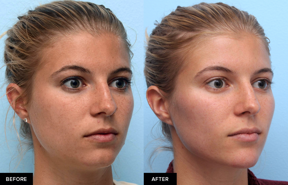 Get A Chiseled Jawline Without Surgery
