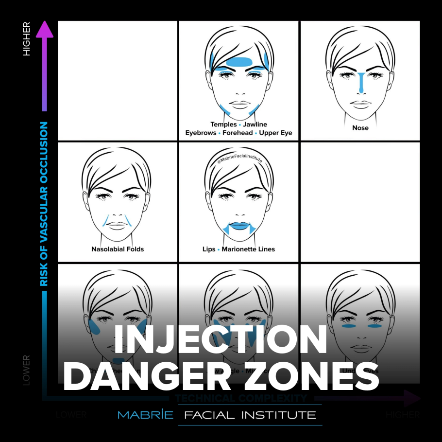 dermal filler injection danger zones diagram