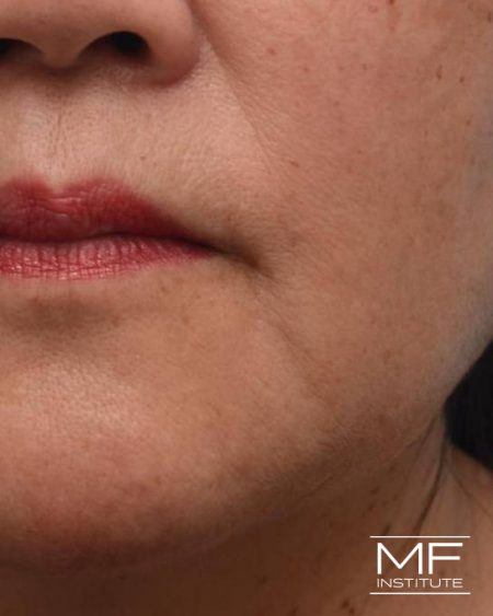 Lower Face Rejuvenation Botox® And Filler For Marionette Lines And Jowls In San Francisco 