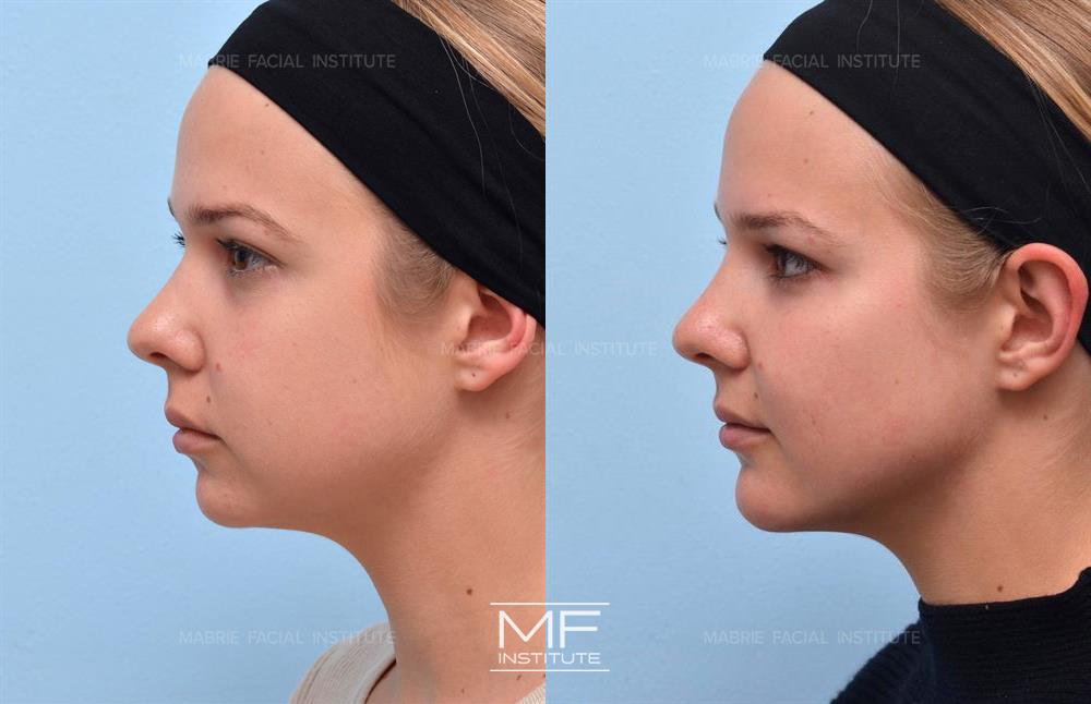 prominent cheekbones vs high cheekbones