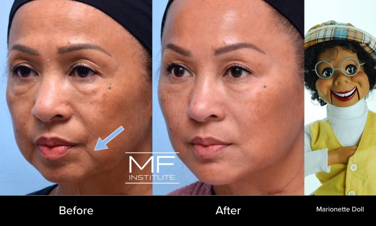 Before And After Marionette Lines Filler A Photo Faq Mabrie Facial Institute