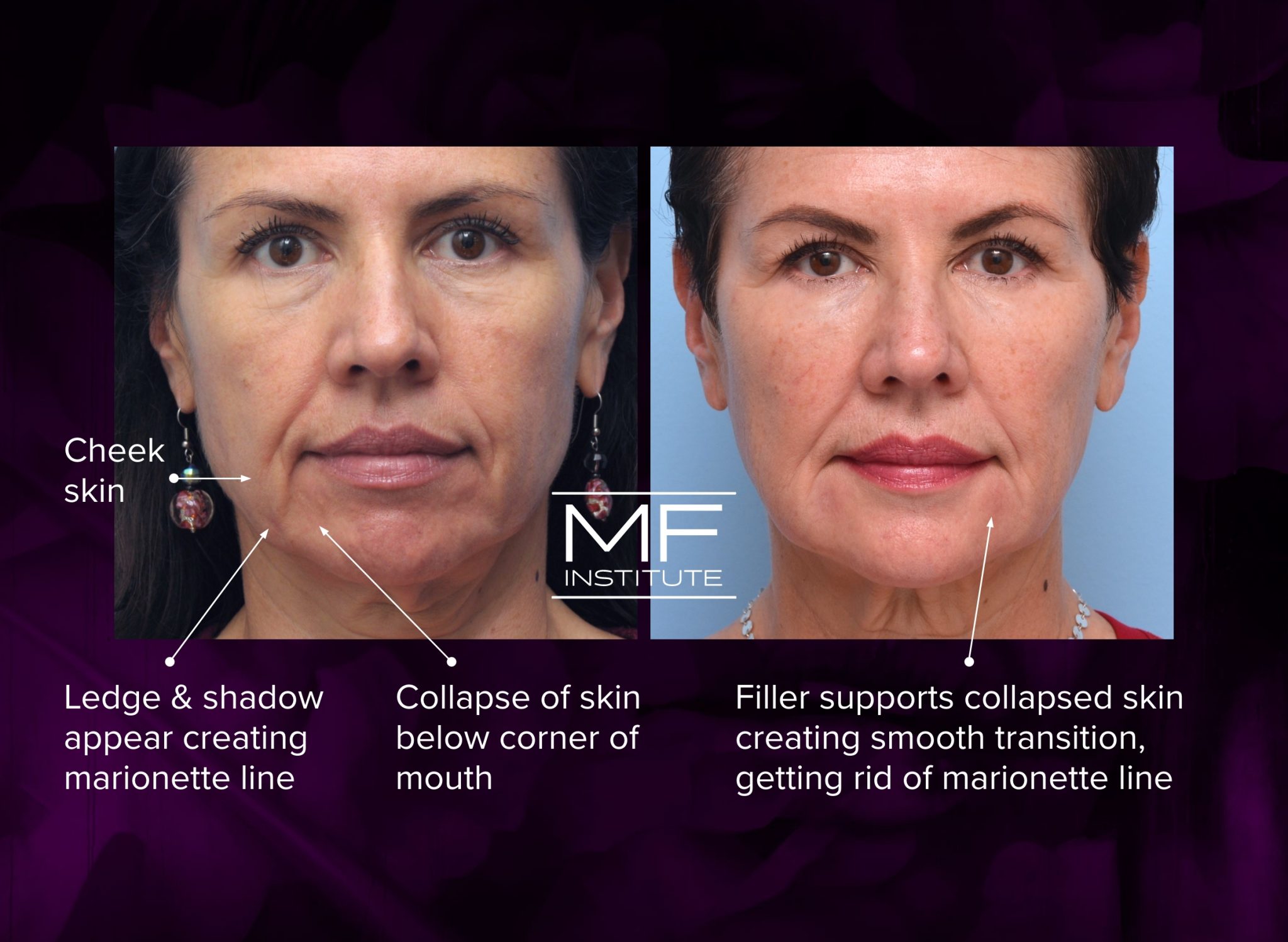 Before and After Marionette Lines Filler: A Photo FAQ | Mabrie Facial ...