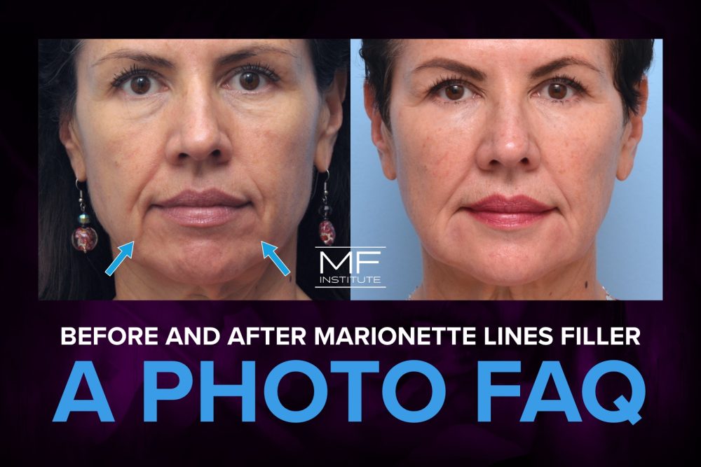 Before and After Lines Filler A Photo FAQ Mabrie Facial