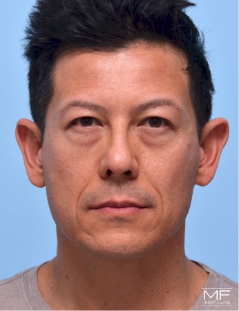 Patient front facing before under eye bag treatment