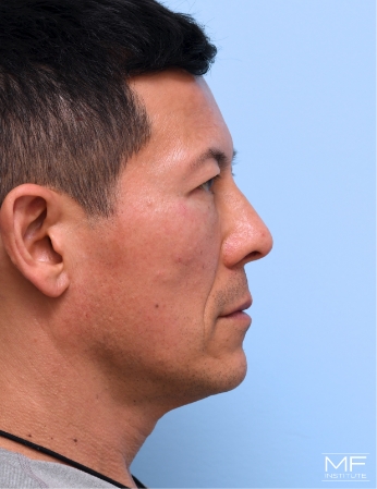 Patient side facing after under eye bag treatment