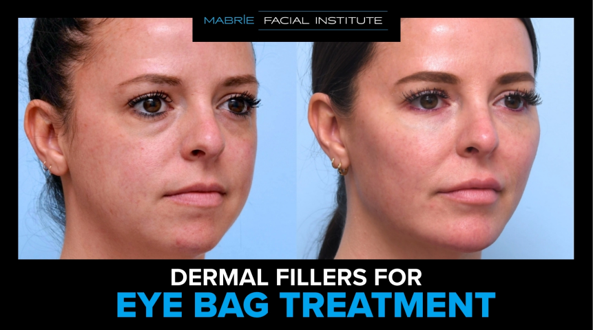 Before-and-after results of MFI under eye filler patient and text that reads 'Dermal Fillers For Eye Bag Treatment'