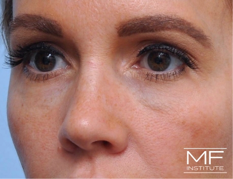 Before 2 treatment process eye filler treatment