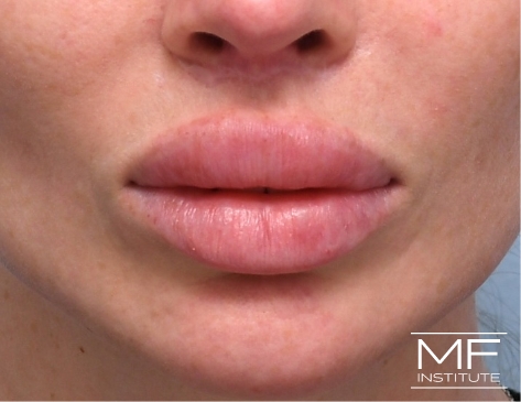 Before 2 treatment process lip treatment