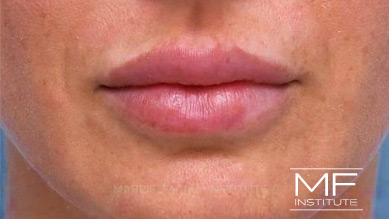 After dissolving lip filler on woman