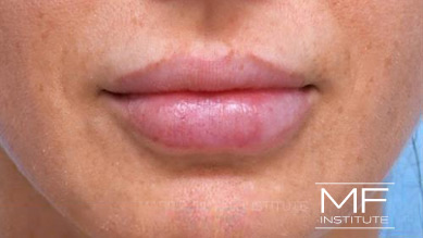 Before dissolving lip filler on woman