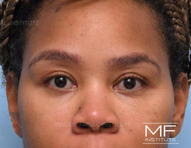 After dissolving under eye filler on woman