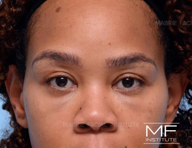 Before dissolving under eye filler on woman