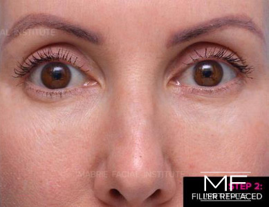 After dissolving under eye filler on woman