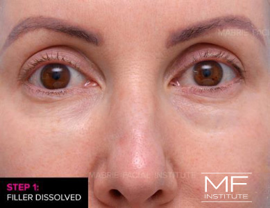 Before dissolving under eye filler on woman