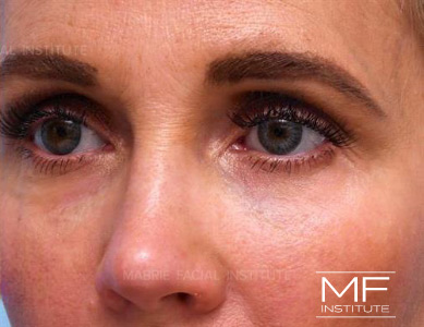 After dissolving under eye filler on woman