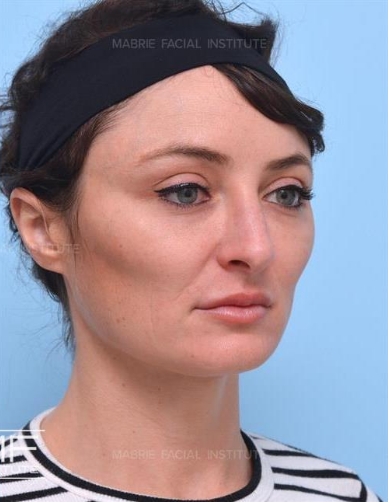 Woman after botox for masseter and jaw