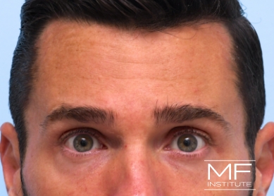 Man after BOTOX for Forehead wrinkles treatment