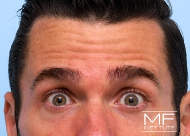 Man before BOTOX for Forehead wrinkles treatment