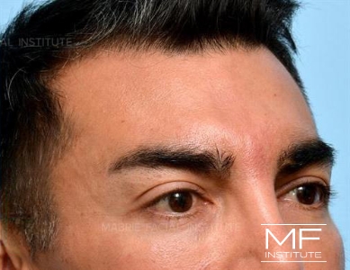 Man after Botox and Filler for Frown Lines treatments