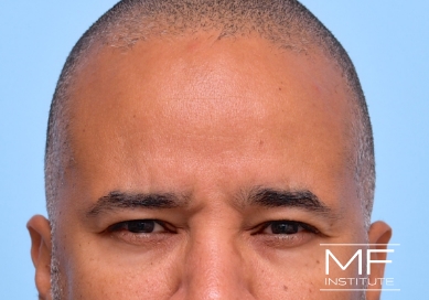 Man after BOTOX for Frown Lines treatment