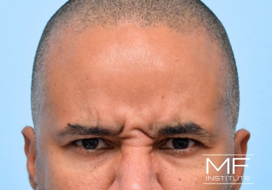 Man before BOTOX for Frown Lines treatment