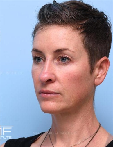 Woman after a complete midface rejuvenation.