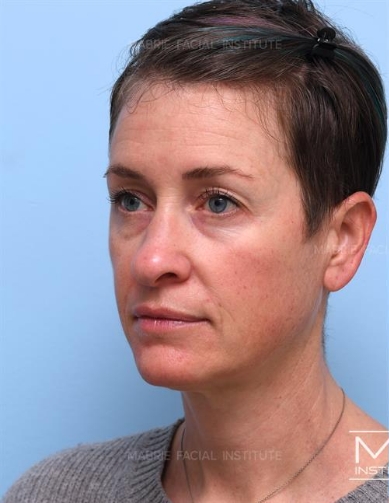 Woman before a complete midface rejuvenation.