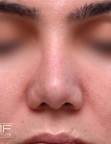 Woman after non-surgical rhinoplasty correction to widen her nasal tip