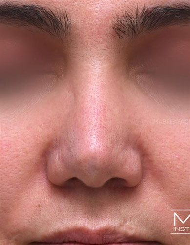 Woman before non-surgical rhinoplasty correction to widen her nasal tip