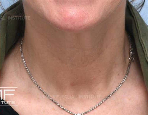 After a Botox For Vertical Neck Bands treatment.