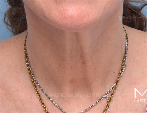 Before a Botox For Vertical Neck Bands treatment.