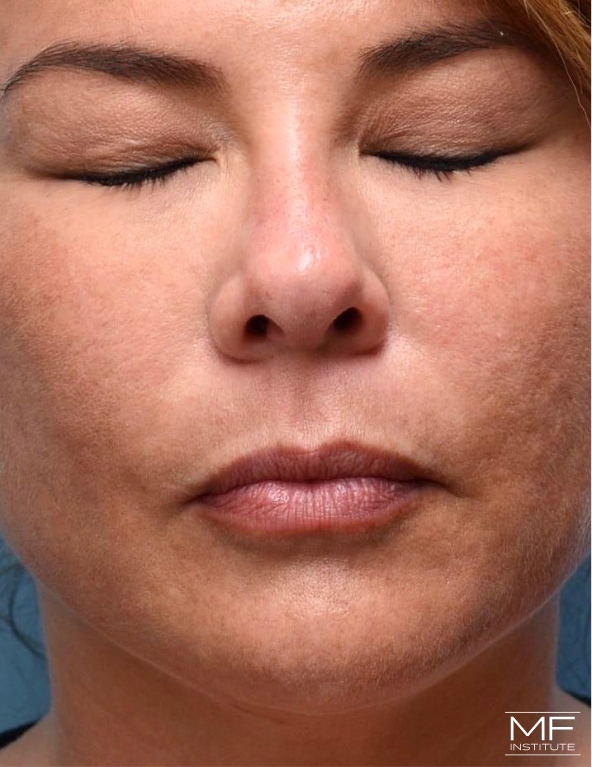 Woman with bruising resolved after nose filler treatment