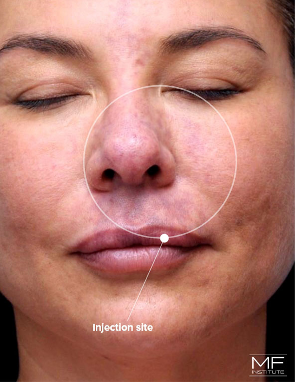 Woman with bruising around her nose after nose filler treatment