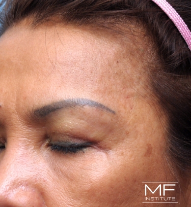 Woman after receiving temple filler treatment