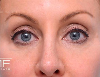 After dissolving under eye filler on woman