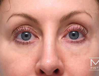 Before dissolving under eye filler on woman