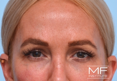 Woman after Botox for forehead wrinkles and frown lines treatment