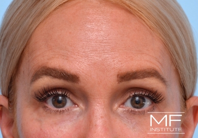 Woman after Botox for forehead wrinkles and frown lines treatment