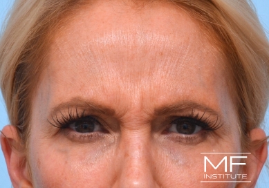 Woman before Botox for forehead wrinkles and frown lines treatment