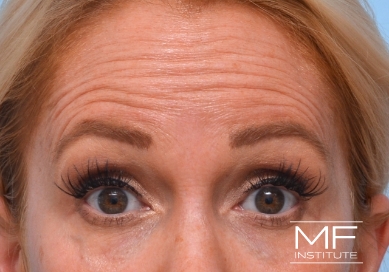 Woman before Botox for forehead wrinkles and frown lines treatment