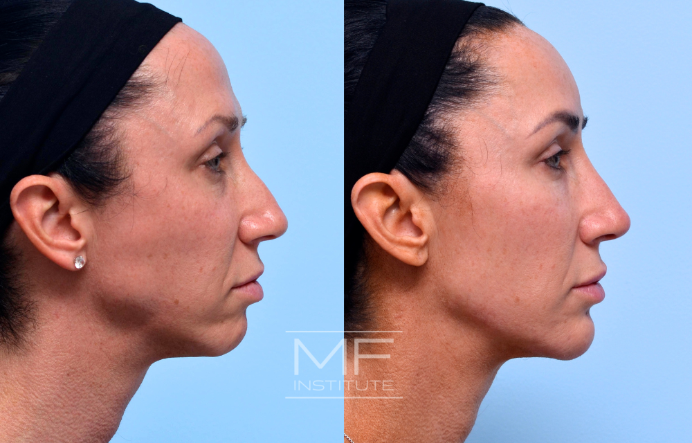 Before-and-after jawline filler results case #624